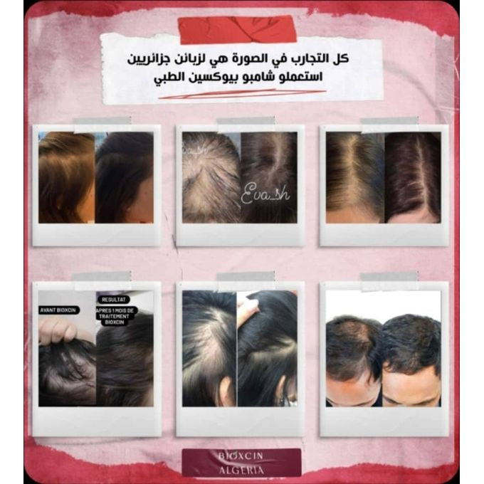 شامبو بيوكسين النباتي بالثوم الأسود ضد تساقط الشعر - للنساء والرجال