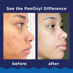 Panoxyl Nettoyant Moussant Contre L'Acné Pour Le Visage Et Le Corps Efficacité Maximale
